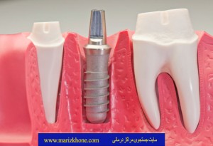 ایمپلنت-دندانپزشکی-روکش دندان-پر کردن دندان-کشیدن دندان-روکش دندان-